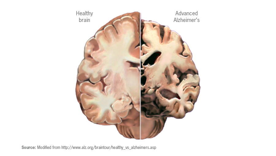 脑萎缩在先进的阿尔茨海默氏症。